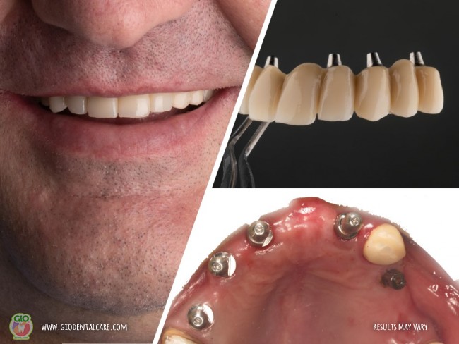 gio-dental-implants-1